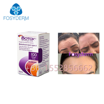 Allergan Botox 100 وحدة Botulinum Toxin مضاد للتجاعيد من النوع A حقن