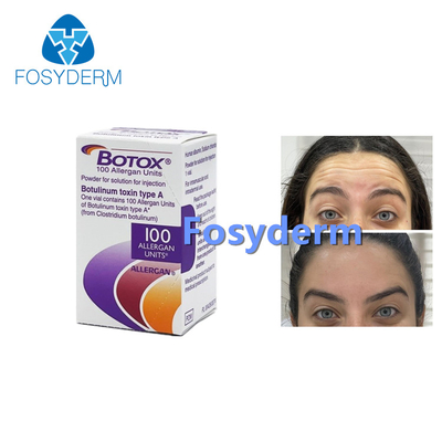 100 وحدة من مادة Allergan Botulinum Toxion لإزالة تجاعيد الوجه من نوع البوتوكس أ