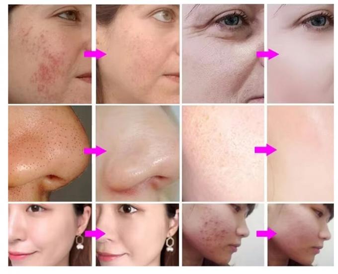 آلات التنظيف للوجه آلة تنظيف الوجه مكافحة التجاعيد المياه أكسجين جيتبيل 3