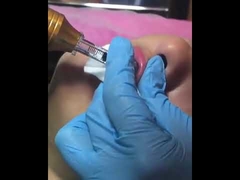 قلم الهيالورون