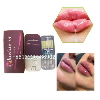 Ultra3 Juvederm Lip Filler Injection 2ml حمض الهيالورونيك الجلدي