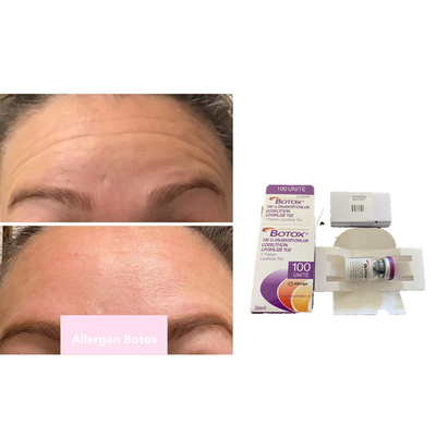 Allergan s 100iu Botulinum Toxin النوع A لمكافحة التجاعيد