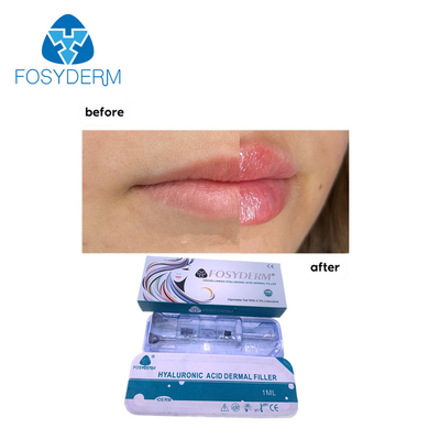 Fosyderm Dermal Lip Fillers 1ml حقن حمض الهيالورونيك لتعزيز الشفاه