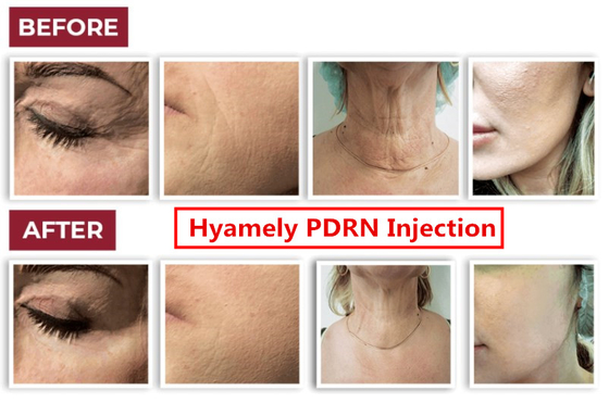 مصل Hyamely Cell Regation Skin Booster PDRN لتبييض الرقبة وحقن الوجه