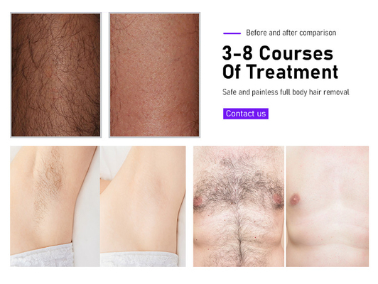 معدات التجميل جهاز إزالة الشعر بالليزر Fosyderm 3 موجات 12 بار