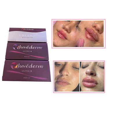 حقن العناية بالبشرة مسكن الشفاه Juvederm حمض الهيالورونيك حشو الجلد للوجه