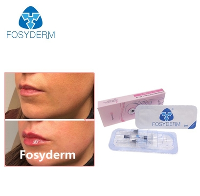 جل Fosyderm 2ml مرتبط Cross Hyaluronic Acid Dermal Filler من أجل تحسين الشفاه