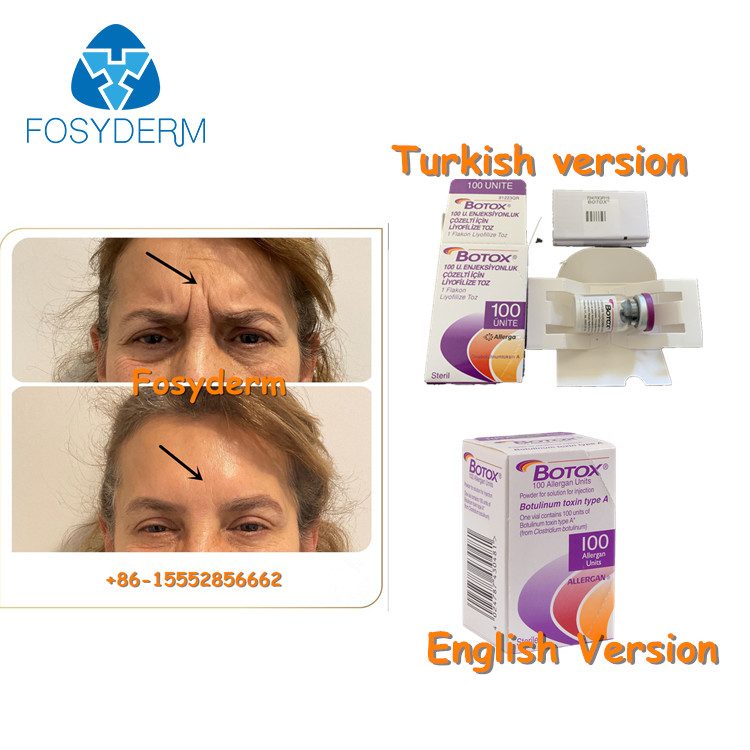 100 وحدة من مادة Allergan Botulinum Toxion لإزالة تجاعيد الوجه من نوع البوتوكس أ