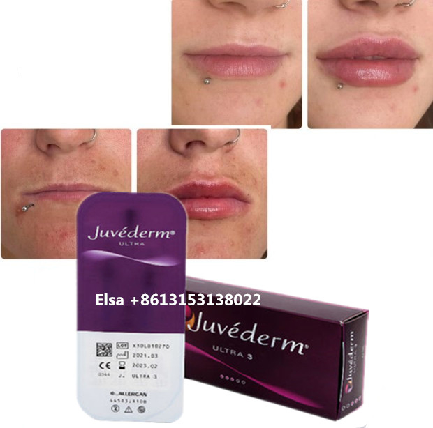 مستحضرات التجميل العناية بالبشرة حقن غسول الشفاه Juvederm حقن لملء الأنف