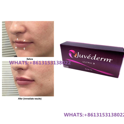 Juvederm حشوة جلدية للشفتين Juvederm Ultra3 Ultra4 الحشوات المملوءة مسبقًا حقنة