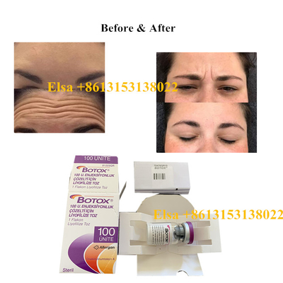 حقن Allergan Botulinum Toxin نوع A 100 وحدة لمكافحة الشيخوخة