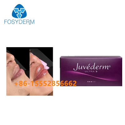حشو جلدي لتعزيز الشفاه Juvederm 2ml حقن حمض الهيالورونيك