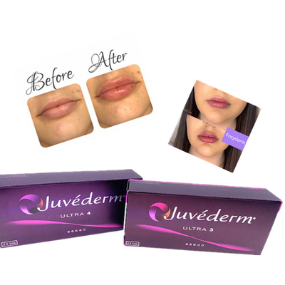 Hyaluronic Acid Dermal Gel Injection Juvederm Lip Filler Ce مكافحة الشيخوخة 2ml