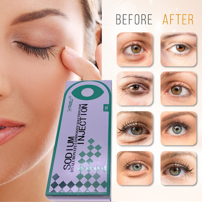 Hyamely إزالة الهالات السوداء حقن ملء أحواض الدموع 1ml