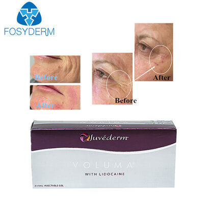 Juvederm Hyaluronic Acid Dermal Filler Face Face Lifting 24mg