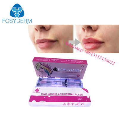 OEM تكبير الشفاه Hyaluronic Acid Dermal Filler Gel Injection